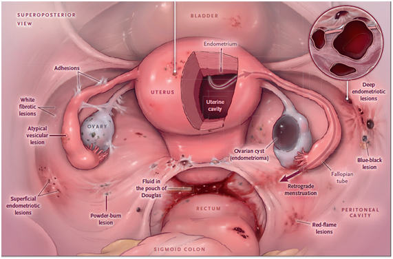 What is Endometriosis?